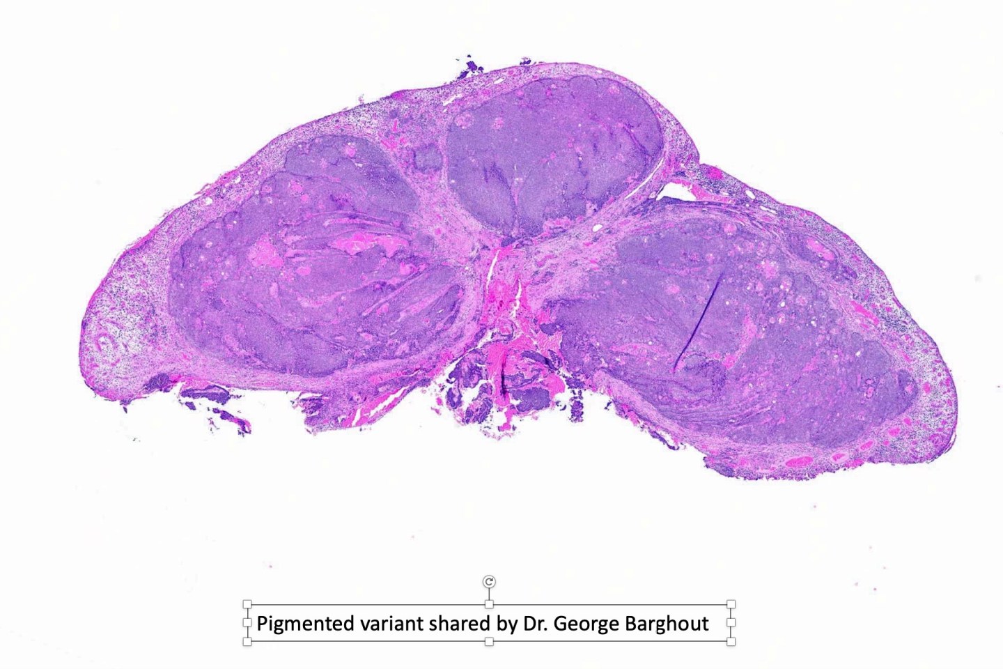 Matrical carcinoma (malignant pilomatricoma, malignant pilomatrixoma ...