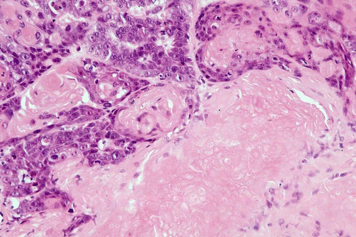 Matrical carcinoma (malignant pilomatricoma, malignant pilomatrixoma ...