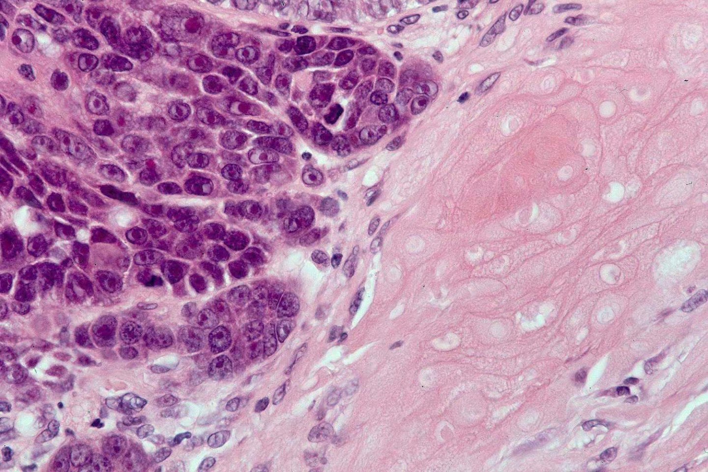 Matrical carcinoma (malignant pilomatricoma, malignant pilomatrixoma ...