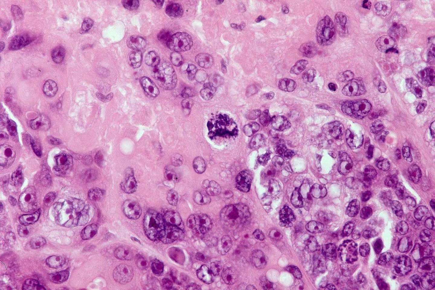Matrical carcinoma (malignant pilomatricoma, malignant pilomatrixoma ...