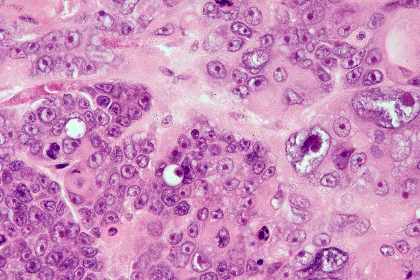 Matrical carcinoma (malignant pilomatricoma, malignant pilomatrixoma ...