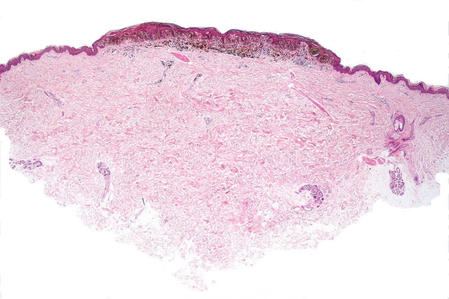 Spingle Pattern Pathology Pigmented spindle cell nevus of Reed – McKee Derm