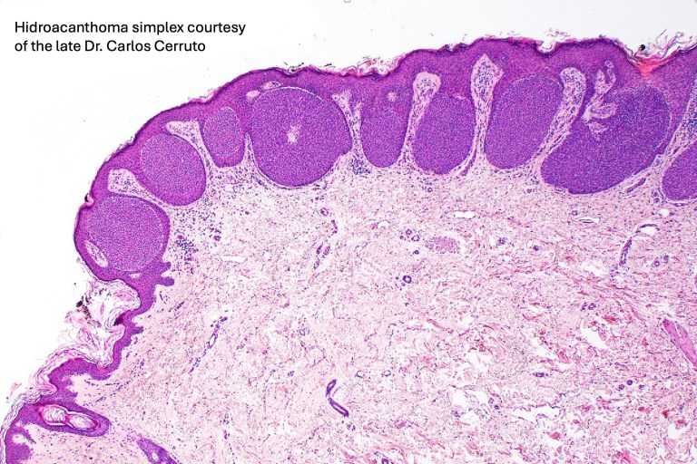 poroma-including-hidroacanthoma-simplex-dermal-duct-tumor-mckee-derm