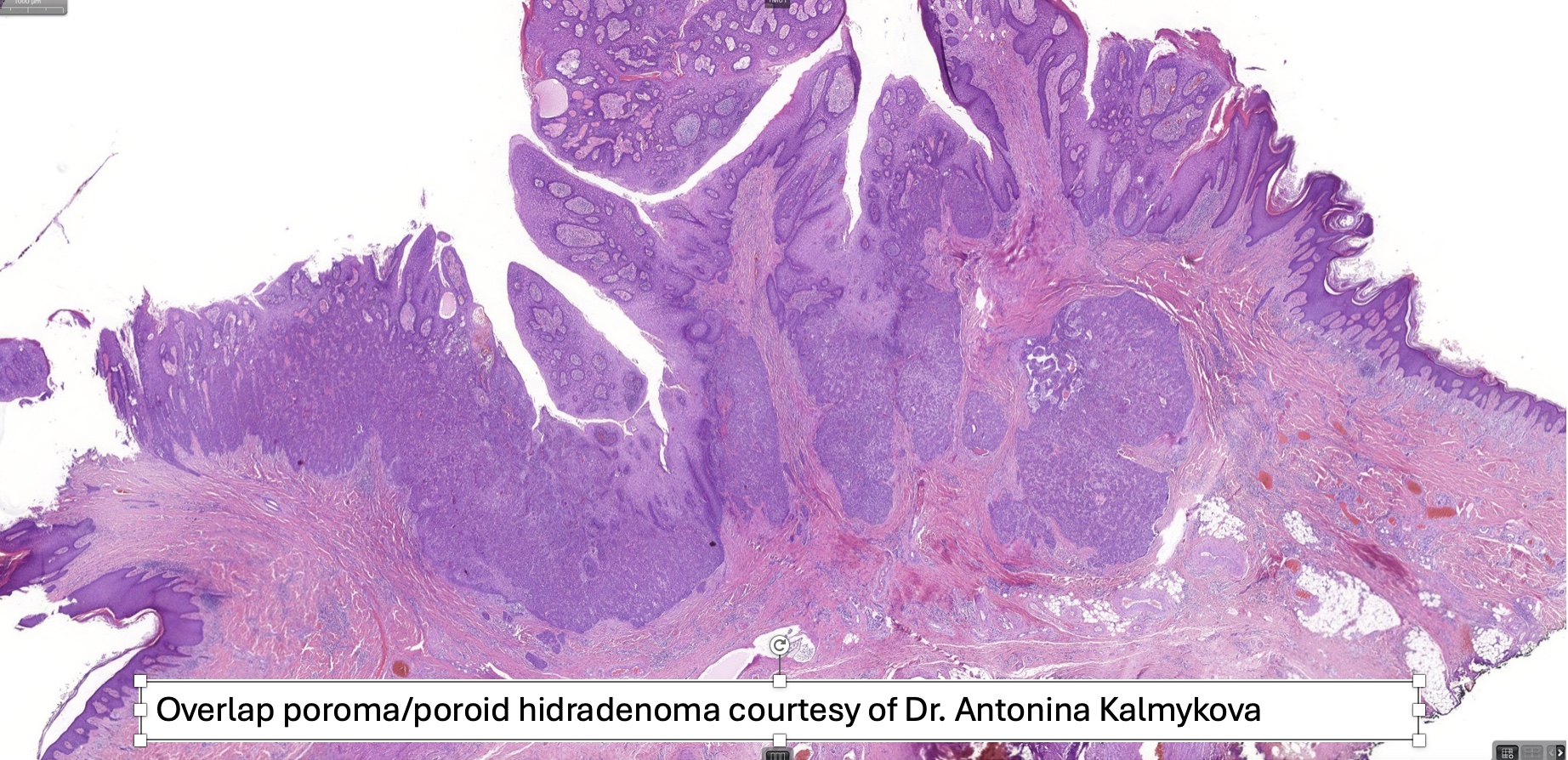 Poroma Including Hidroacanthoma Simplex Dermal Duct Tumor McKee Derm Poroma Including Hidroacanthoma Simplex Dermal Duct Tumor McKee Derm